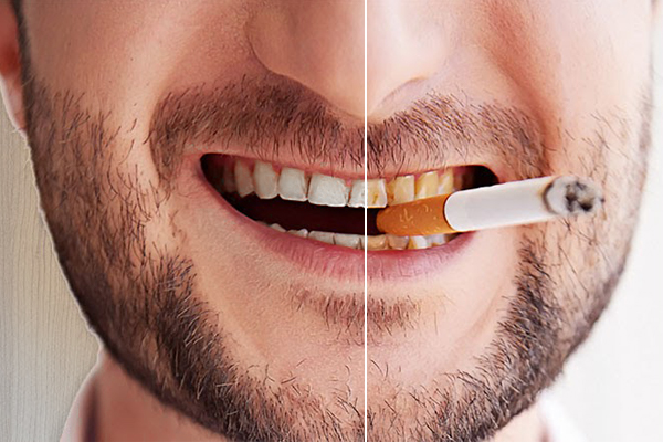 Răng ố vàng - Tác hại của thuốc lá bạn nên khắc phục sớm
